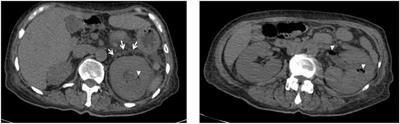 Sepsis caused by emphysematous pyelonephritis: A case report